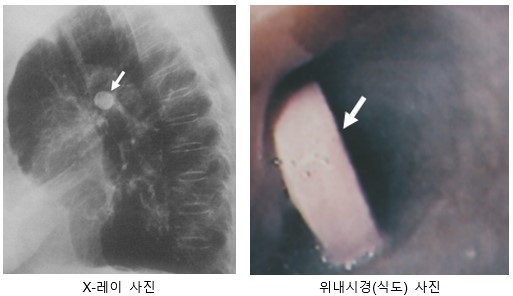 츄어블정-식도폐쇄